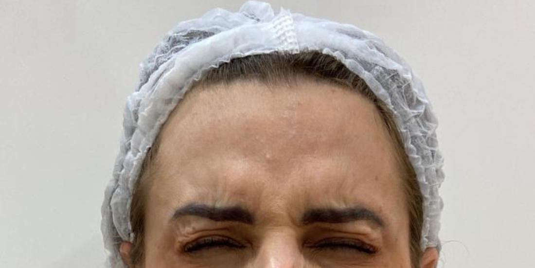 Antes do procedimento — Caso 4