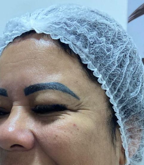 Antes do procedimento — Caso 5