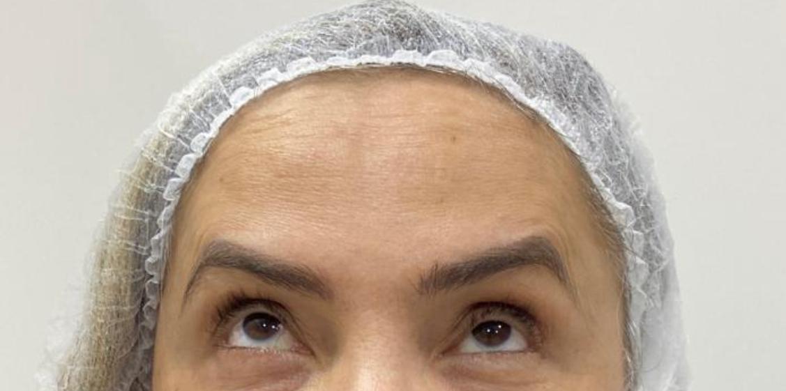 Depois do procedimento — Caso 1