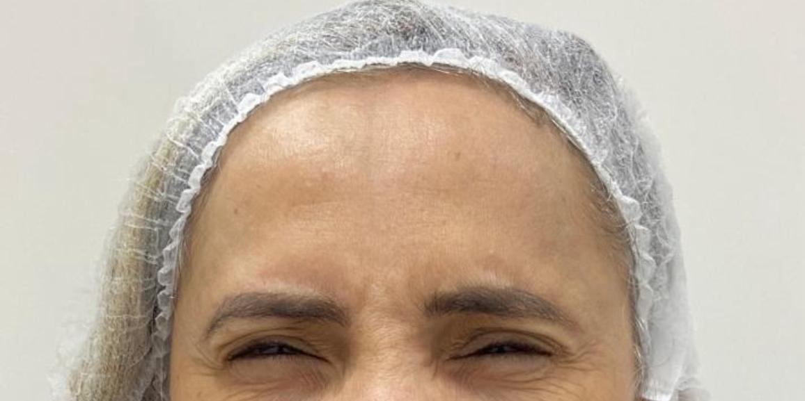 Depois do procedimento — Caso 2