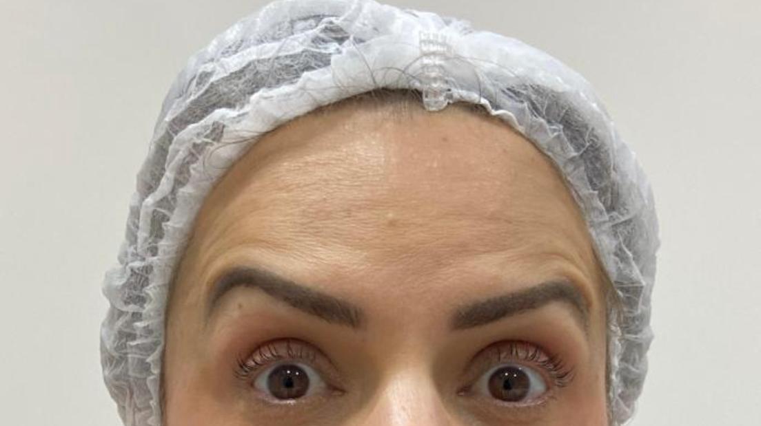 Depois do procedimento — Caso 3