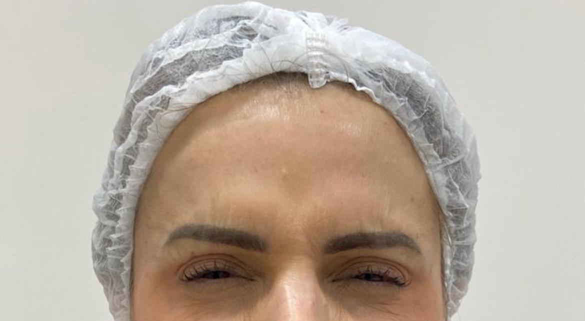 Depois do procedimento — Caso 4